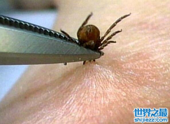 真实的蜱虫叮咬后伤口图片，蜱虫叮咬会致命小心处理
